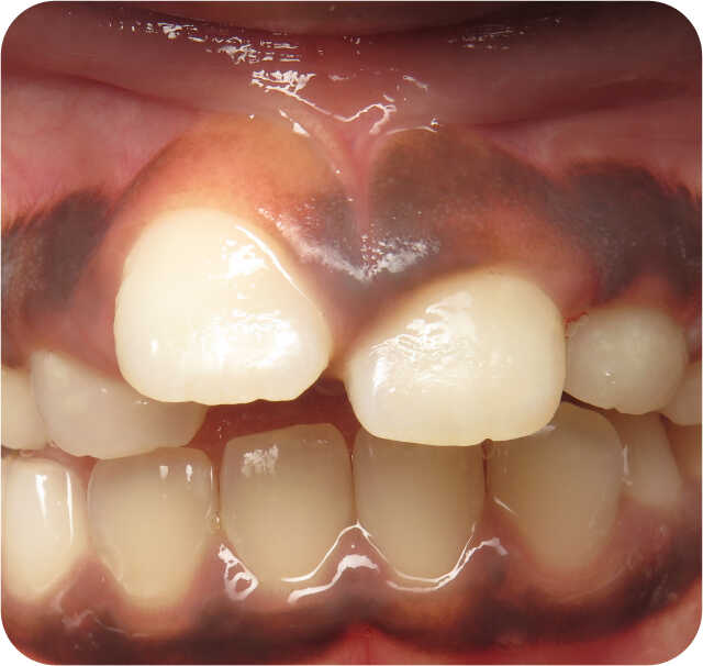 non-extraction gallery