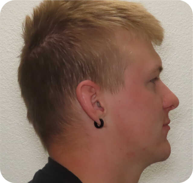 prominent-lower-jaw gallery